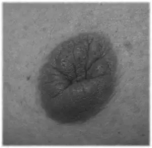 Mamelons ombiliqués